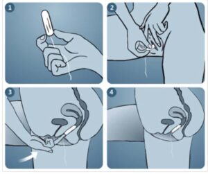 cách sử dụng tampon không cần đẩy